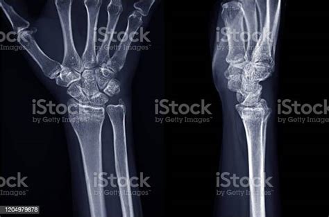 Xray Image Of Right Wrist Joint Ap And Lateral View Stock Photo