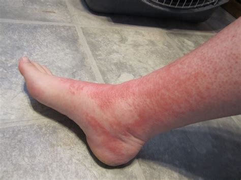 Bright Red Rash On Leg Above Ankle Foto Bugil Bokep