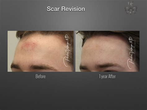 Scar Revision Keloid Treatment New Orleans Center For Aesthetics