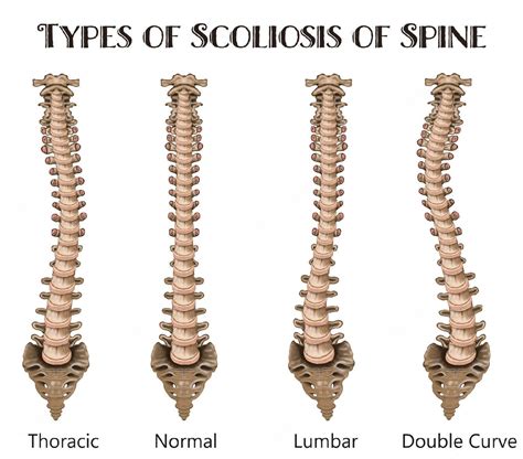What Is Scoliosis