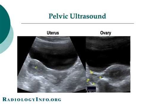 Primary indications for female pelvic us examination are pelvic pain, abnormal vaginal bleeding, and suspicion of pelvic mass. Your Radiologist Explains: Pelvic & Obstetric Ultrasound ...