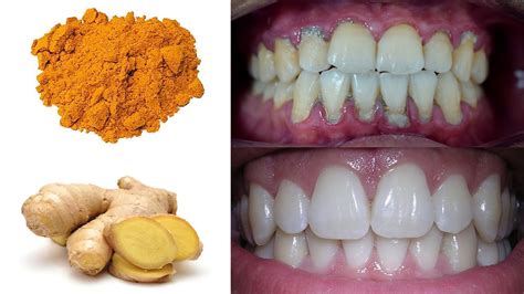 How To Treat Gum Disease This Homemade Paste Fix Receding Gums And