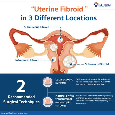 The Difference Of Uterine Fibroid In Different Locations Vejthani