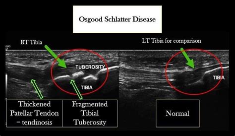 Thickening And Hypoechoic Texture Of The Patellar Tendon Suggesting