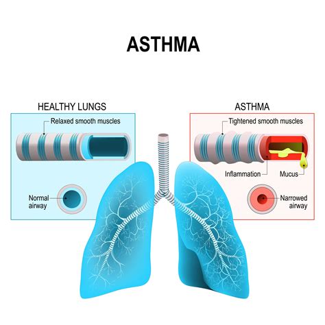 Is Asthma A Chronic Health Condition Cares Healthy