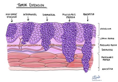 Squamous Cell Carcinoma Of The Esophagus Mypathologyreport Ca