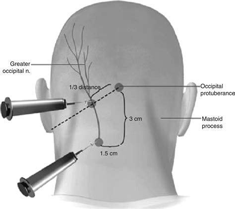 Local Anaesthetic Versus Steroid In Greater Occipital