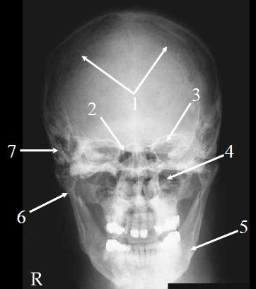 Ap, lat, smv, ap axial (townes), pa axial (caldwell) learn with flashcards, games and more — for free. Medical Imaging Technology: Skull Radiography- Lateral and ...