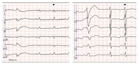 Cureus Recognition Of Pulseless Ventricular Tachycardia Through The Second Analysis Of