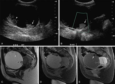 Malignant Ovarian Masses Radiology Key