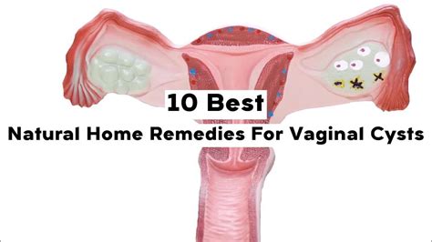 10 best natural home remedies for vaginal cysts youtube