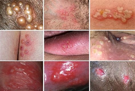 If you want to accelerate the healing process, there are a handful of natural and holistic remedies you can try. How Long Does a Genital Herpes Outbreak Last? - Public Health
