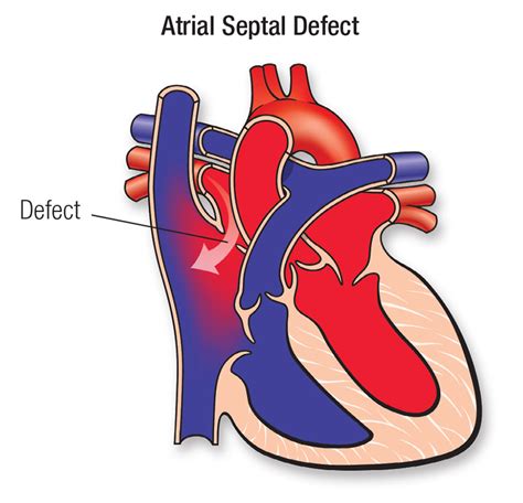 Atrial Septal Defect Seattle Childrens