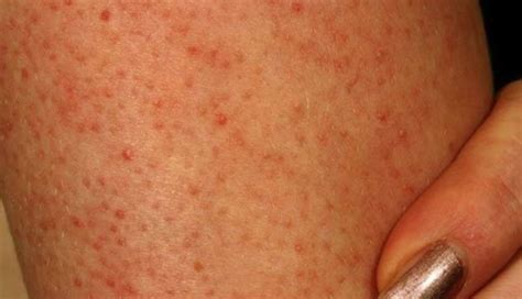 Red Spots On Legs Causes Small Raised Flat Or Itchy