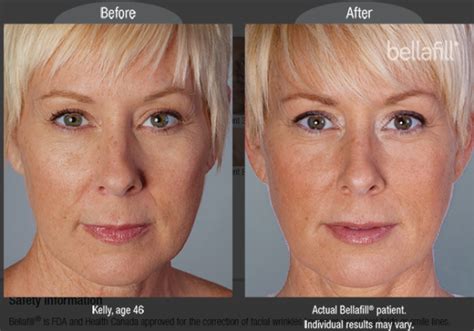 Long Lasting Collagen Injectables And Dermal Fillers Bellafill