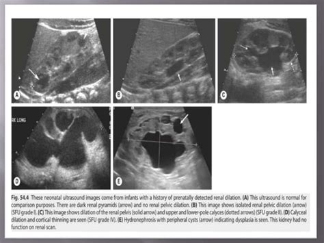 Ureteropelvic Junction Obstruction In Children