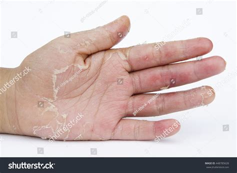 Dry Hands Peel Dermatitis Eczema Stock Photo Edit Now 448785628