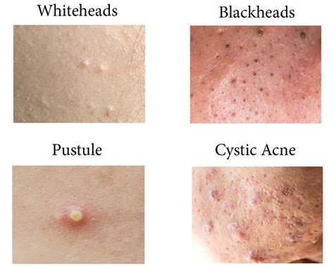 Dr Pimple Popper Reveals The Acne You Shouldnt Pop Pimple Causes