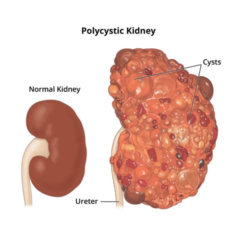 Polycystic Kidney Disease Pkd Niddk