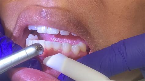 Houston Cosmetic Dentistquick Laser Procedure To Show Less Gum When
