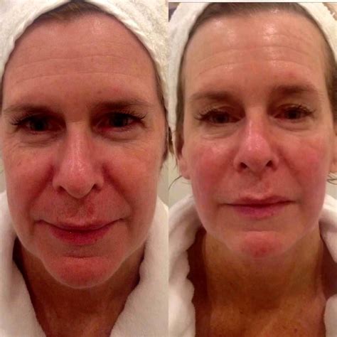 Before And After Of Thermage 10 Thermage Facelift