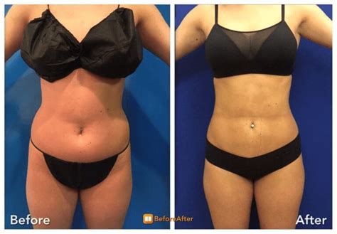Tumescent Liposuction In Nyc Neinstein Plastic Surgery