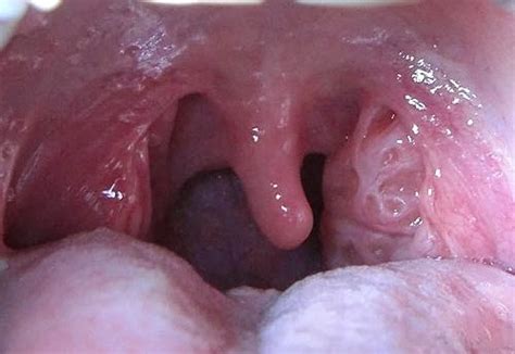 Swollen Tonsils Causes And Treatment Medical Information And Guidance