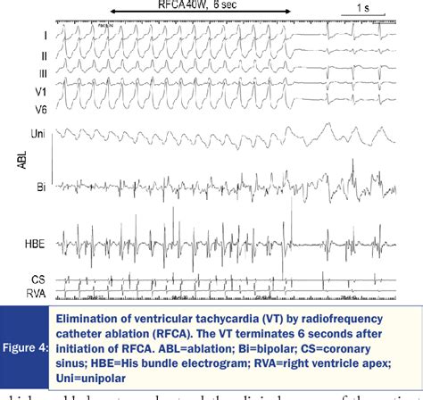 Figure From Successful Ablation Of Single Reentrant Ventricular