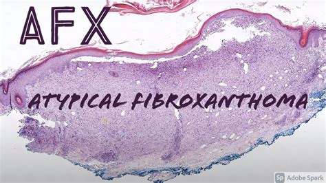 Afx Atypical Fibroxanthoma Dermpath Dermatology Pathology