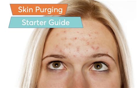 How Long Does A Skin Purge Last It Can Happen After Using Excellent