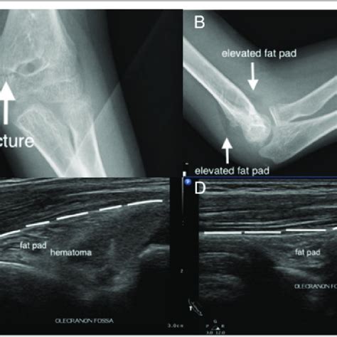 Sonographic Fat Pad Sign A Teenage Boy Injured His Elbow After A Fall