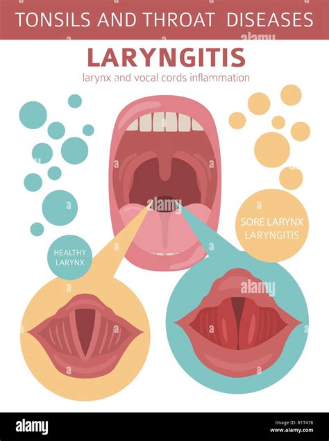 Tonsils And Throat Diseases Laryngitis Symptoms Treatment Icon Set Medical Infographic Design
