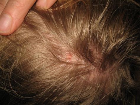 How Do You Get Rid Of Those Disturbing Lice Dry Scalp Lice Removal