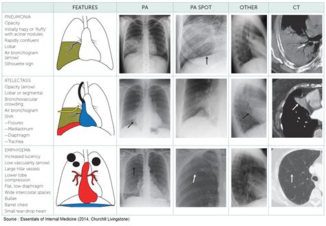 Radiographic Features Of Pulmonary Diseases Emergency Medicine Kenya