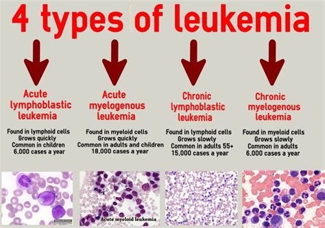 Leukemia A Type Of Blood Cancer