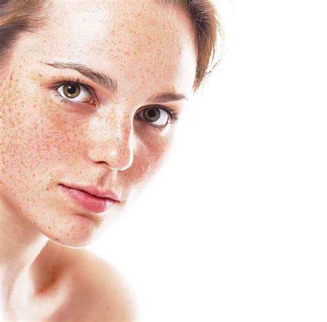 Mole Vs Freckle How To Spot The Difference Beverly Hills Md