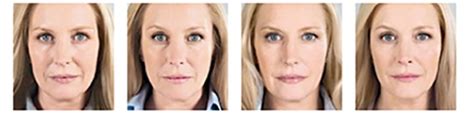 Facial Injectables Suwanee Duluth Lawrenceville Vitality Ageless Center