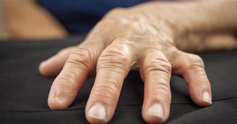Symptoms Of Rheumatoid Arthritis In The Hands And Fingers Livestrongcom