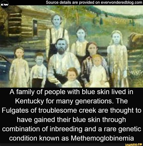 A Sal Of People With Blue Skin Lived In Kentucky For Many Generations