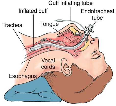 Endotracheal Tube Ett Sizes Proper Placement And Useful Airway