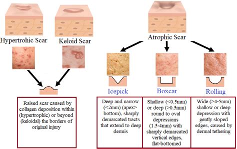 Figure1 Samples From Five Different Types Of Acne Scars And Their