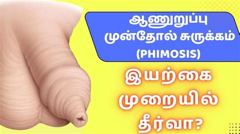 Phimosis Patient Handout