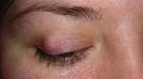 Photos of Infected Eyelid Home Remedies