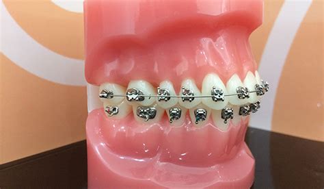 How Do Braces Work On Your Teeth Comprehensive Guide