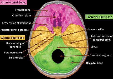 Diagnosis Of Skull Base Osteomyelitis Radiographics