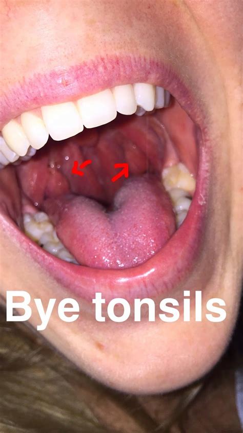 Oh Brother Adult Tonsillectomy Survival Guide Tonsillectomy Recovery