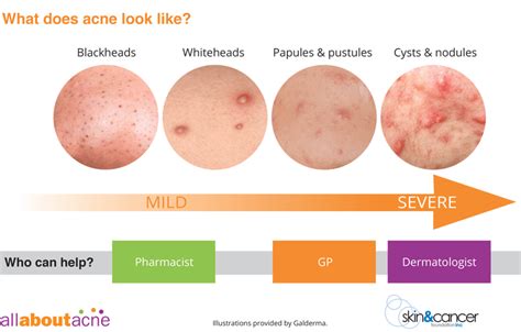 Grade Of Acne Severity Medical Diagram About Skin Problems From