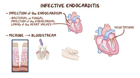 Infective Endocarditis Etiopathogenesis Morphology And Complications Images