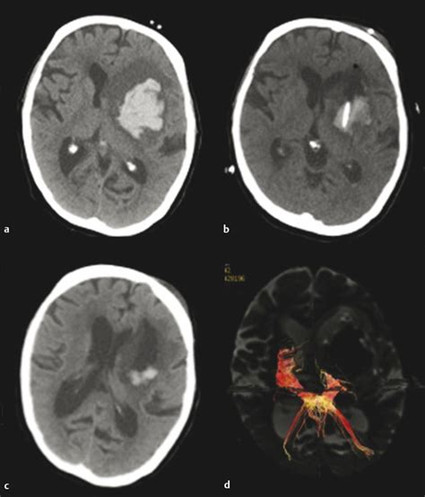 Minimally Invasive Approaches For Spontaneous Intracerebral Hemorrhage Neupsy Key