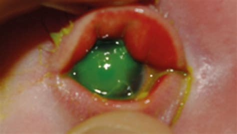 Herpes Simplex Ophthalmia Neonatorum A Sight Threatening Diagnosis British Journal Of General